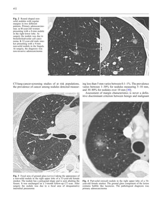 452



Fig. 2 Round shaped non-
solid nodules with regular
margins in two different
patients. Primary adenocarcino-
mas. a 46-year-old women
presenting with a 8-mm nodule
in the right lower lobe. At
surgery the nodule was due to
bronchioloalveolar cell carci-
noma. b 32-year-old male smo-
ker presenting with a 9-mm
non-solid nodule in the lingula.
At surgery, the diagnosis was
non-invasive adenocarcinoma




CT-lung-cancer-screening studies of at risk populations,             ing less than 5 mm varies between 0.1–1%. The prevalence
the prevalence of cancer among nodules detected measur-              varies between 1–30% for nodules measuring 5–10 mm,
                                                                     and 30–80% for nodules over 10 mm [30].
                                                                        Assessment of margin characteristics is never a defin-
                                                                     itive discriminant criterion between benign and malignant




Fig. 3 Focal area of ground glass (arrow) taking the appearance of
a non-solid nodule in the right upper lobe of a 53-year-old female
smoker. The nodule has a polygonal shape and is seen abutting the    Fig. 4 Part-solid (mixed) nodule in the right upper lobe of a 54-
fissure. It was unchanged on a 3-month follow-up CT scan. After      year-old female smoker. The ground glass component of the lesion
surgery the nodule was due to a focal area of desquamative           contains bubble like lucencies. The pathological diagnosis was
interstitial pneumonia                                               primary adenocarcinoma
 