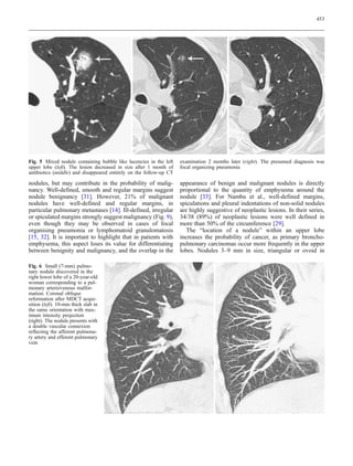 453




Fig. 5 Mixed nodule containing bubble like lucencies in the left    examination 2 months later (right). The presumed diagnosis was
upper lobe (left). The lesion decreased in size after 1 month of    focal organizing pneumonia
antibiotics (middle) and disappeared entirely on the follow-up CT

nodules, but may contribute in the probability of malig-            appearance of benign and malignant nodules is directly
nancy. Well-defined, smooth and regular margins suggest             proportional to the quantity of emphysema around the
nodule benignancy [31]. However, 21% of malignant                   nodule [33]. For Nambu et al., well-defined margins,
nodules have well-defined and regular margins, in                   spiculations and pleural indentations of non-solid nodules
particular pulmonary metastases [14]. Ill-defined, irregular        are highly suggestive of neoplastic lesions. In their series,
or spiculated margins strongly suggest malignancy (Fig. 9),         34/38 (89%) of neoplastic lesions were well defined in
even though they may be observed in cases of focal                  more than 50% of the circumference [29].
organising pneumonia or lymphomatoid granulomatosis                    The “location of a nodule” within an upper lobe
[15, 32]. It is important to highlight that in patients with        increases the probability of cancer, as primary broncho-
emphysema, this aspect loses its value for differentiating          pulmonary carcinomas occur more frequently in the upper
between benignity and malignancy, and the overlap in the            lobes. Nodules 3–9 mm in size, triangular or ovoid in

Fig. 6 Small (7-mm) pulmo-
nary nodule discovered in the
right lower lobe of a 20-year-old
woman corresponding to a pul-
monary arteriovenous malfor-
mation. Coronal oblique
reformation after MDCT acqui-
sition (left). 10-mm thick slab in
the same orientation with max-
imum intensity projection
(right). The nodule presents with
a double vascular connexion
reflecting the afferent pulmona-
ry artery and efferent pulmonary
vein
 