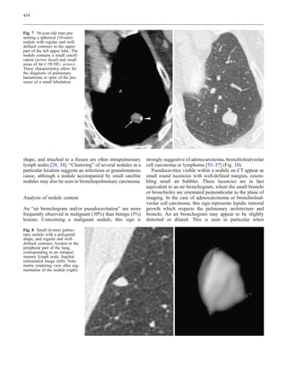 454



Fig. 7 58-year-old man pre-
senting a spherical (10-mm)
nodule with regular and well-
defined contours in the upper
part of the left upper lobe. The
nodule contains a small calcifi-
cation (arrow head) and small
areas of fat (−50 HU; arrow).
These characteristics allow for
the diagnosis of pulmonary
hamartoma in spite of the pre-
sence of a small lobulation




shape, and attached to a fissure are often intrapulmonary     strongly suggestive of adenocarcinoma, bronchioloalveolar
lymph nodes [28, 34]. “Clustering” of several nodules in a    cell carcinoma or lymphoma [35–37] (Fig. 10).
particular location suggests an infectious or granulomatous      Pseudocavities visible within a nodule on CT appear as
cause, although a nodule accompanied by small satellite       small round lucencies with well-defined margins, resem-
nodules may also be seen in bronchopulmonary carcinoma.       bling small air bubbles. These lucencies are in fact
                                                              equivalent to an air bronchogram, where the small bronchi
                                                              or bronchioles are orientated perpendicular to the plane of
Analysis of nodule content                                    imaging. In the case of adenocarcinoma or bronchioloal-
                                                              veolar cell carcinoma, this sign represents lepidic tumoral
An “air bronchogram and/or pseudocavitation” are more         growth which respects the pulmonary architecture and
frequently observed in malignant (30%) than benign (5%)       bronchi. An air bronchogram may appear to be slightly
lesions. Concerning a malignant nodule, this sign is          distorted or dilated. This is seen in particular when

Fig. 8 Small (6-mm) pulmo-
nary nodule with a polygonal
shape, and regular and well-
defined contours, located in the
peripheral part of the lung,
corresponding to an intrapul-
monary lymph node. Sagittal
reformatted image (left). Volu-
metric rendering view after seg-
mentation of the nodule (right)
 