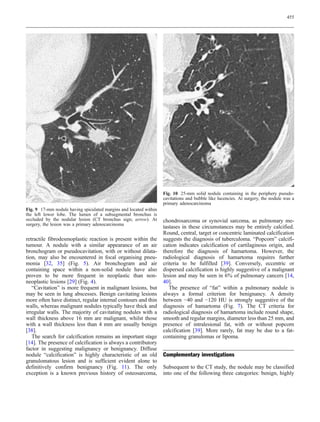 455




                                                                   Fig. 10 25-mm solid nodule containing in the periphery pseudo-
                                                                   cavitations and bubble like lucencies. At surgery, the nodule was a
                                                                   primary adenocarcinoma
Fig. 9 17-mm nodule having spiculated margins and located within
the left lower lobe. The lumen of a subsegmental bronchus is
occluded by the nodular lesion (CT bronchus sign; arrow). At       chondrosarcoma or synovial sarcoma, as pulmonary me-
surgery, the lesion was a primary adenocarcinoma
                                                                   tastases in these circumstances may be entirely calcified.
                                                                   Round, central, target or concentric laminated calcification
retractile fibrodesmoplastic reaction is present within the        suggests the diagnosis of tuberculoma. “Popcorn” calcifi-
tumour. A nodule with a similar appearance of an air               cation indicates calcification of cartilaginous origin, and
bronchogram or pseudocavitation, with or without dilata-           therefore the diagnosis of hamartoma. However, the
tion, may also be encountered in focal organising pneu-            radiological diagnosis of hamartoma requires further
monia [32, 35] (Fig. 5). Air bronchogram and air                   criteria to be fulfilled [39]. Conversely, eccentric or
containing space within a non-solid nodule have also               dispersed calcification is highly suggestive of a malignant
proven to be more frequent in neoplastic than non-                 lesion and may be seen in 6% of pulmonary cancers [14,
neoplastic lesions [29] (Fig. 4).                                  40].
   “Cavitation” is more frequent in malignant lesions, but            The presence of “fat” within a pulmonary nodule is
may be seen in lung abscesses. Benign cavitating lesions           always a formal criterion for benignancy. A density
more often have distinct, regular internal contours and thin       between −40 and −120 HU is strongly suggestive of the
walls, whereas malignant nodules typically have thick and          diagnosis of hamartoma (Fig. 7). The CT criteria for
irregular walls. The majority of cavitating nodules with a         radiological diagnosis of hamartoma include round shape,
wall thickness above 16 mm are malignant, whilst those             smooth and regular margins, diameter less than 25 mm, and
with a wall thickness less than 4 mm are usually benign            presence of intralesional fat, with or without popcorn
[38].                                                              calcification [39]. More rarely, fat may be due to a fat-
   The search for calcification remains an important stage         containing granulomas or lipoma.
[14]. The presence of calcification is always a contributory
factor in suggesting malignancy or benignancy. Diffuse
nodule “calcification” is highly characteristic of an old          Complementary investigations
granulomatous lesion and is sufficient evident alone to
definitively confirm benignancy (Fig. 11). The only                Subsequent to the CT study, the nodule may be classified
exception is a known previous history of osteosarcoma,             into one of the following three categories: benign, highly
 