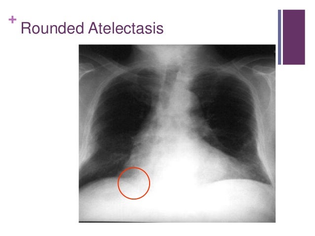 What is lung nodular density and atelectasis?