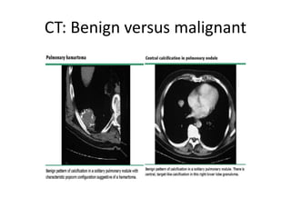 Solitary pulmonary nodule vp.pptx