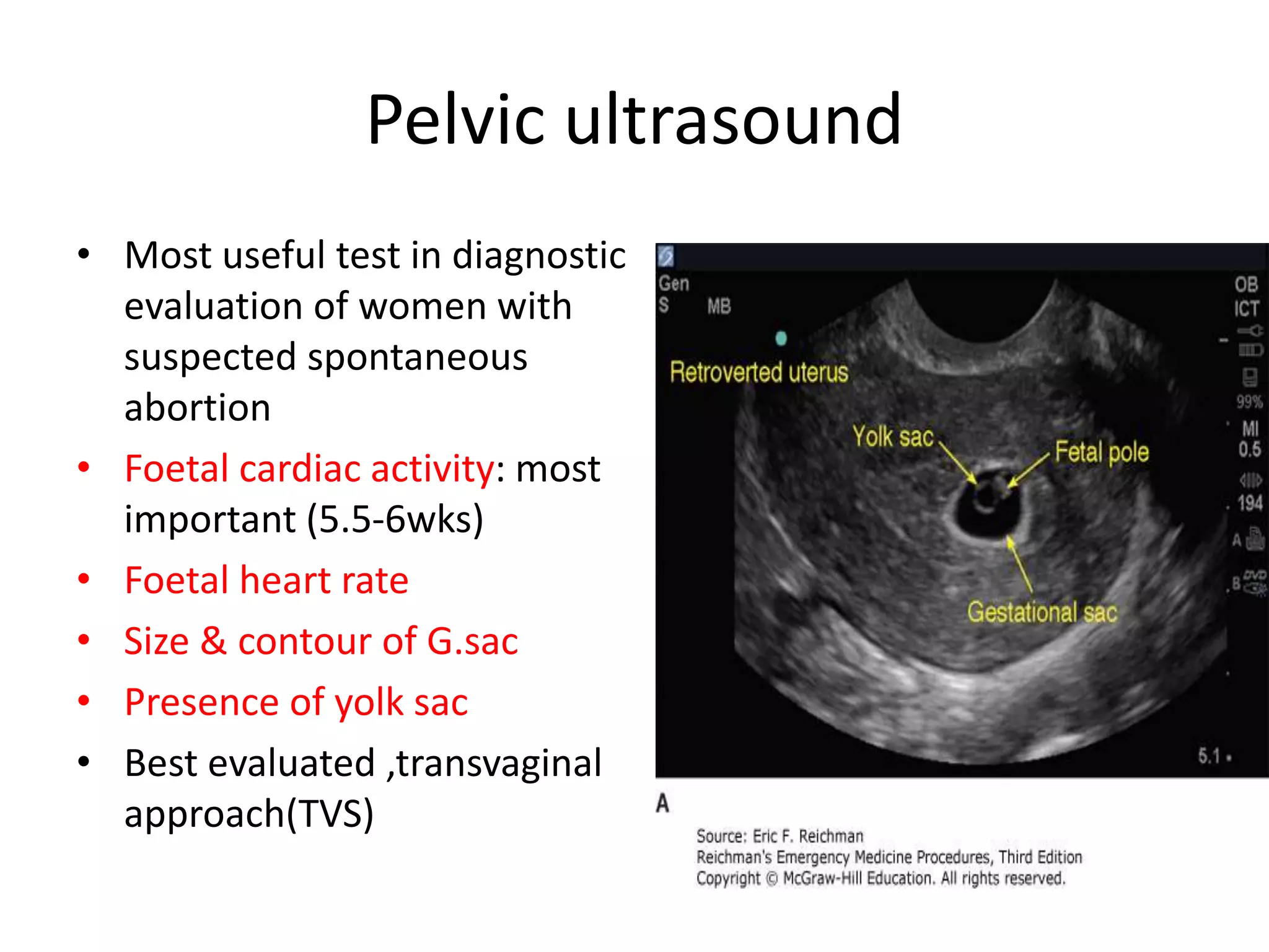 Pelvic ultrasound
• Most useful test in diagnostic
evaluation of women with
suspected spontaneous
abortion
• Foetal cardiac activity: most
important (5.5-6wks)
• Foetal heart rate
• Size & contour of G.sac
• Presence of yolk sac
• Best evaluated ,transvaginal
approach(TVS)
 