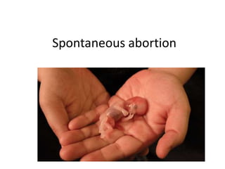 Spontaneous abortion
 