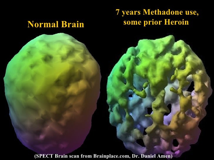 This Is Your Brain On Drugs Gif