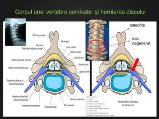 Corpul unei vertebre cervicale şi hernierea discului
osteofite
disc
degenerat
 