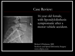 Case Review:
   16 year old female,
   with Spondylolisthesis
   symptomatic after a
   motor vehicle accident.




Robert S Pashman, MD
Scoliosis and Spinal Deformity Surgery
www.eSpine.com
 