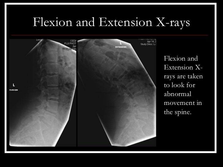 Case Review B Spondylolisthesis Surgery