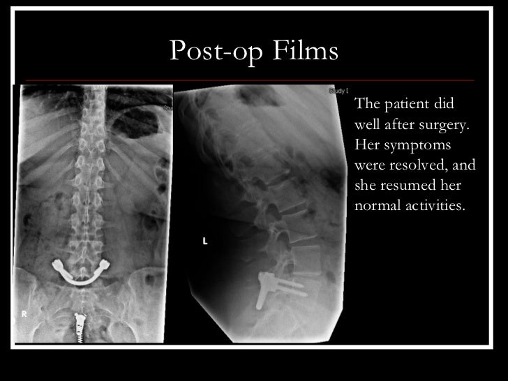 Lumbar spondylosis surgery success rate image