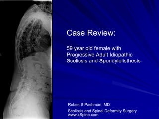 Case Review:
59 year old female with
Progressive Adult Idiopathic
Scoliosis and Spondylolisthesis




Robert S Pashman, MD
Scoliosis and Spinal Deformity Surgery
www.eSpine.com
 
