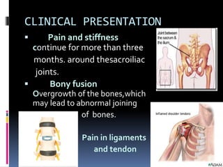 CLINICAL PRESENTATION
 Pain and stiffness
continue for more than three
months. around thesacroiliac
joints.
 Bony fusion
Overgrowth of the bones,which
may lead to abnormal joining
 of bones.
Pain in ligaments
and tendon
 