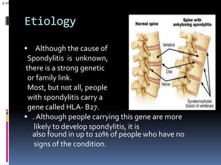 Etiology
 Although the cause of
Spondylitis is unknown,
there is a strong genetic
or family link.
Most, but not all, people
with spondylitis carry a
gene called HLA- B27.
 . Although people carrying this gene are more
likely to develop spondylitis, it is
also found in up to 10% of people who have no
signs of the condition.
ly link. Most, but not all, people with spondylitis carry a gene called HLA-B27. Although people carrying this gene are more likely to develop spondylitis, it isalso fou
 