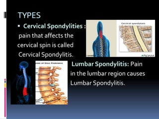TYPES
 Cervical Spondylities :
pain that affects the
cervical spin is called
Cervical Spondylitis.
Lumbar Spondylitis: Pain
in the lumbar region causes
Lumbar Spondylitis.
 