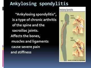 Ankylosing spondylitis
“Ankylosing spondylitis”,
is a type of chronic arthritis
of the spine and the
sacroiliac joints.
Affects the bones,
muscles and ligaments
cause severe pain
and stiffness
 