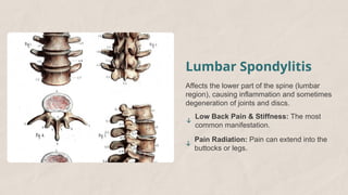 Spondylitis Ribs Spondylitis (A Chronic Inflammatory Disease of the Spine).pptx