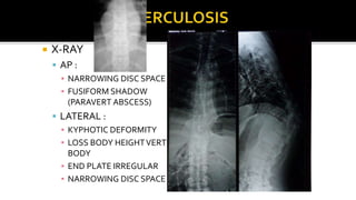  X-RAY
 AP :
▪ NARROWING DISC SPACE
▪ FUSIFORM SHADOW
(PARAVERT ABSCESS)
 LATERAL :
▪ KYPHOTIC DEFORMITY
▪ LOSS BODY HEIGHTVERT
BODY
▪ END PLATE IRREGULAR
▪ NARROWING DISC SPACE
 