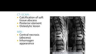 CT-SCAN :
 Calcification of soft
tissue abscess
 Posterior element
 Osteolytic lesion
MRI :
 Central necrosis
(abscess)
 Inhomogen
appearance
 