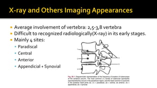  Average involvement of vertebra: 2,5-3,8 vertebra
 Difficult to recognized radiologically(X-ray) in its early stages.
 Mainly 4 sites:
 Paradiscal
 Central
 Anterior
 Appendicial + Synovial
 
