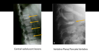 Central radiolucent lesions Vertebra Plana/ PancakeVertebra
 