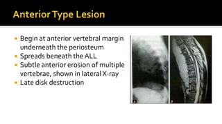  Begin at anterior vertebral margin
underneath the periosteum
 Spreads beneath the ALL
 Subtle anterior erosion of multiple
vertebrae, shown in lateral X-ray
 Late disk destruction
 