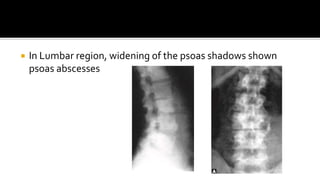 In Lumbar region, widening of the psoas shadows shown
psoas abscesses
 