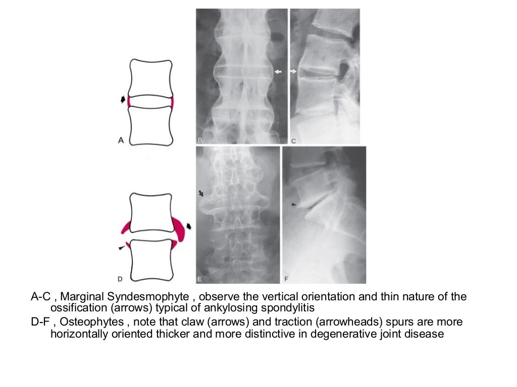 Diagnostic Imaging of Spondyloarthropathies