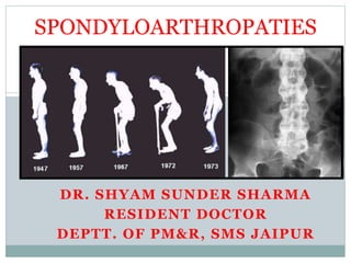 SPONDYLOARTHROPATIES
DR. SHYAM SUNDER SHARMA
RESIDENT DOCTOR
DEPTT. OF PM&R, SMS JAIPUR
 