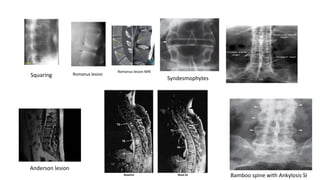Syndesmophytes
Bamboo spine with Ankylosis SI
Squaring Romanus lesion
Anderson lesion
Romanus lesion MRI
 