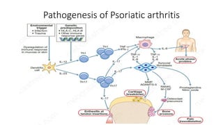 Pathogenesis of Psoriatic arthritis
 