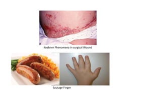 Koebner Phenomena in surgical Wound
Sausage Finger
 
