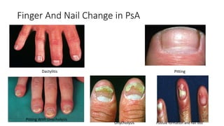 Finger And Nail Change in PsA
Pitting
Pitting With Onycholysis
Onycholysis Pustule formation and nail loss
Dactylitis
 
