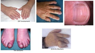 H0rizontal line
Predominant DIPDIP Involvement
Toe dactylitis
Arthritis Mutilans
 