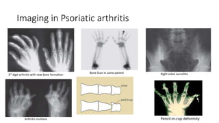 Imaging in Psoriatic arthritis
3rd digit arthritis with new bone formation
Bone Scan in same patient Right sided sacroilitis
Arthritis mutilans Pencil-in-cup deformity
 