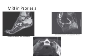 MRI in Psoriasis
Tlonavicular disease with bone edema
Synovial enhancement and suprapatellar effusion
SI
 