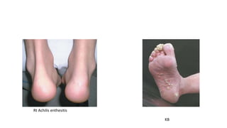 KB
Rt Achilis enthesitis
 