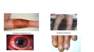 Pyoderma Gangrenosum Erythema nodosum
 