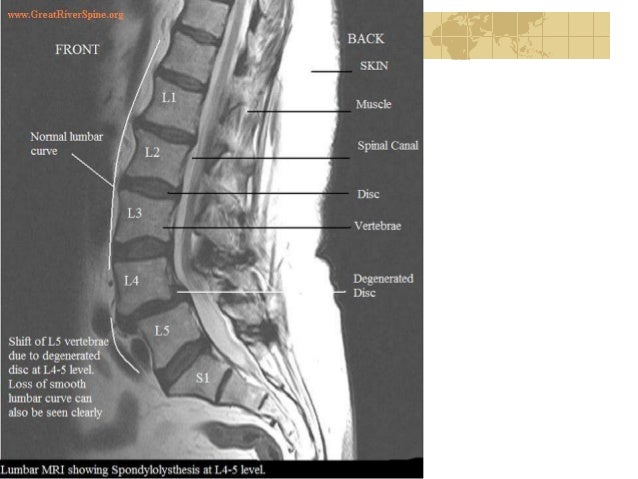 lumbar spondylolisthesis