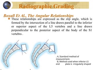 Comprehensive Overview of Spondylolisthesis: Anatomy, Classification ...