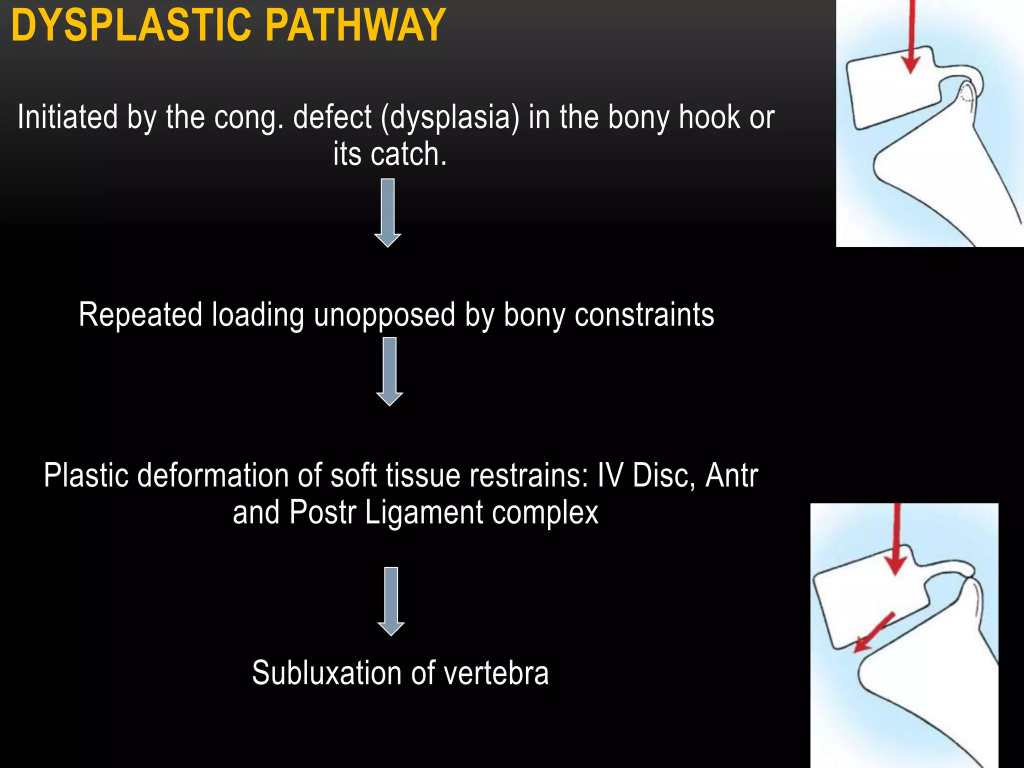 SPONDYLOLISTHESIS: DIAGNOSIS, CLASSIFICATION, EVALUATION AND MANAGEMENT ...