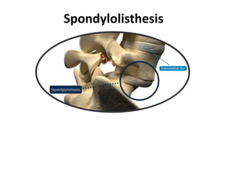 Spondylolisthesis
 