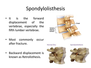 Spondylolisthesis
• It is the forward
displacement of the
vertebrae, especially the
fifth lumber vertebrae.
• Most commonly occur
after fracture.
• Backward displacement is
known as Retrolisthesis.
 