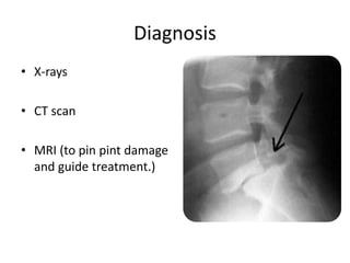 Diagnosis
• X-rays
• CT scan
• MRI (to pin pint damage
and guide treatment.)
 
