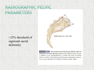 >25% threshold of
signicant sacral
deformity
 