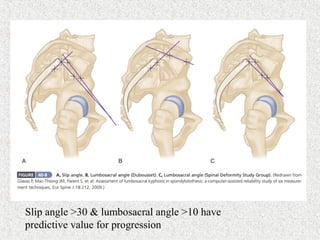 Slip angle >30 & lumbosacral angle >10 have
predictive value for progression
 