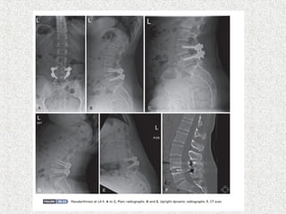 Spondylolisthesis