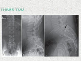 Spondylolisthesis
