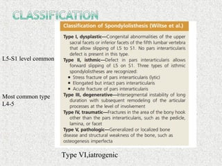 Type VI,iatrogenic
Most common type
L4-5
L5-S1 level common
 