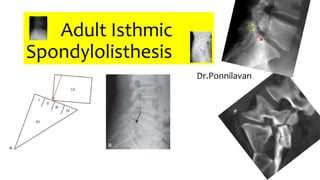 Adult Isthmic
Spondylolisthesis
Dr.Ponnilavan
 