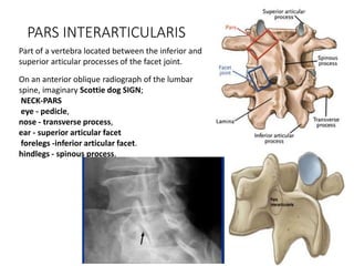 Part Interarticularis Spondylolisthesis | PPTX