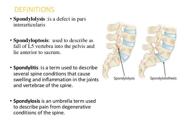 Spondylolisthesis surgery picture